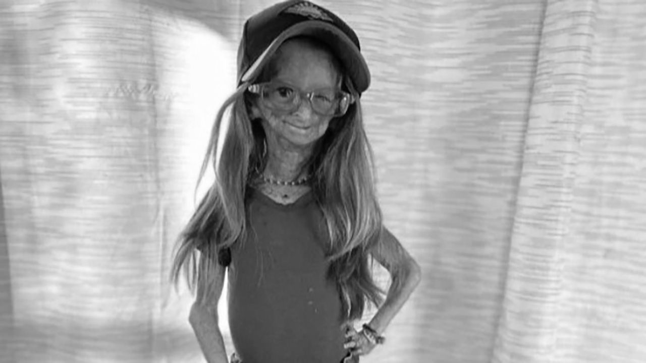 Adalia Rose miała zaledwie 15 lat (fot. FB/Adalia Rose) Adalia Rose miała zaledwie 15 lat (fot. FB/Adalia Rose)