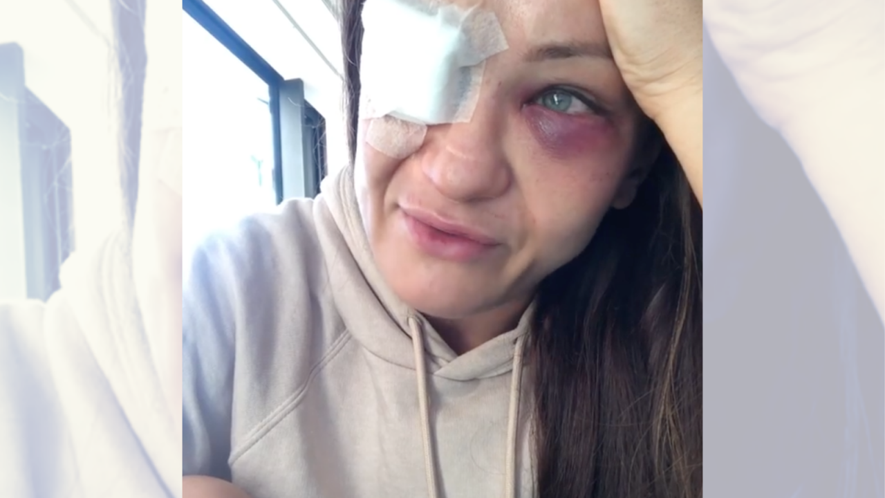 Polska Zawodniczka Mma Karolina Kowalkiewicz Doznala Ciezkiej Kontuzji W Walce Wieszwiecej Tvp Info