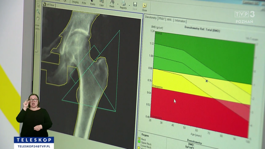 Osteoporoza - cichy złodziej kości. Groźna choroba atakuje (fot. TVP3 Poznań)