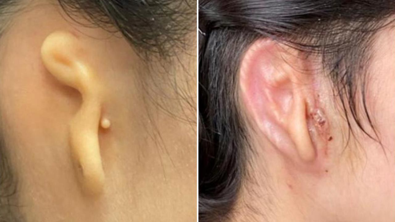 20–letniej pacjentce wszczepiono prawe ucho (fot. 3DBio Therapeutics)