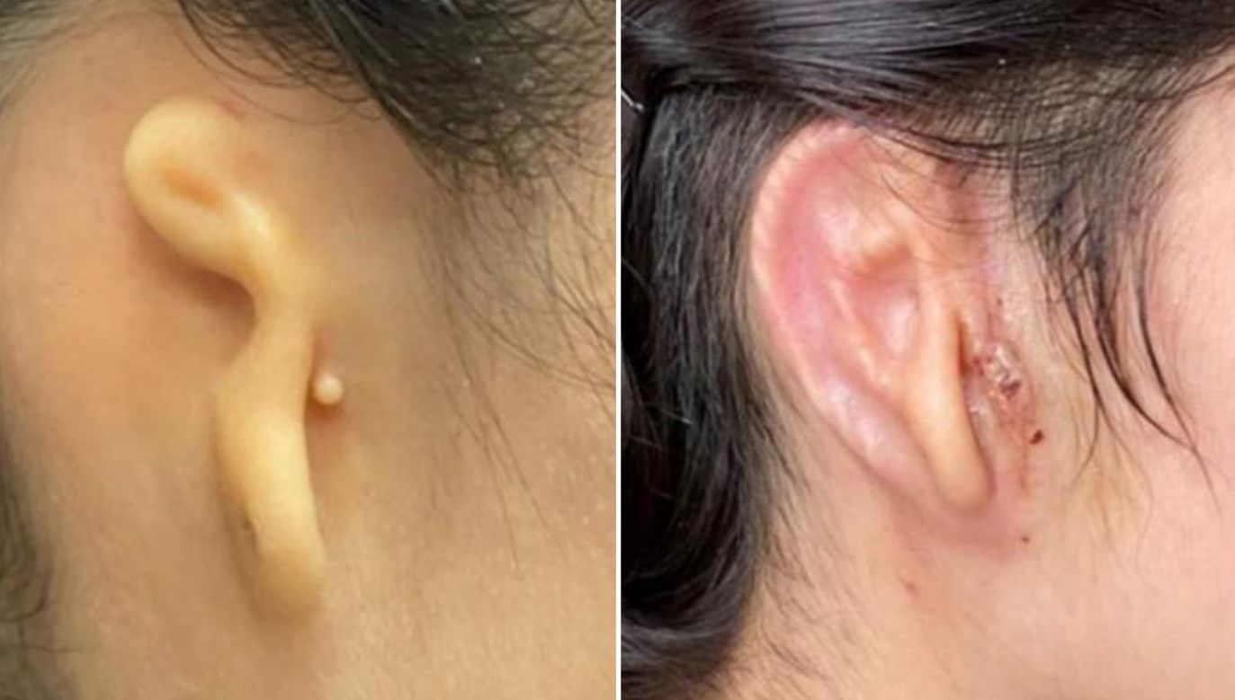 20–letniej pacjentce wszczepiono prawe ucho (fot. 3DBio Therapeutics)